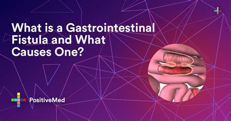 Gastrointestinal Fistula: Causes, Symptoms, and。